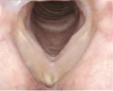 Patient 13, 12 months after PAPZIMEOS treatment.