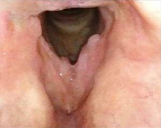 Patient 13 before PAPZIMEOS treatment.