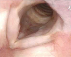 Patient 11, 12 months after PAPZIMEOS treatment.