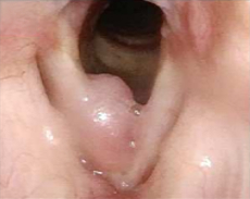 Patient 11 before PAPZIMEOS treatment.