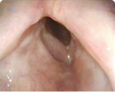 Patient 5, 12 months after PAPZIMEOS treatment.