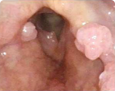 Patient 5 before PAPZIMEOS treatment.