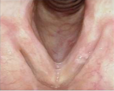 Patient 7, 12 months after PAPZIMEOS treatment.