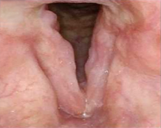 Patient 7 before PAPZIMEOS treatment.